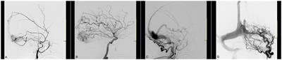 Case report: Association between PTEN-gene variant and an aggressive case of multiple dAVFs